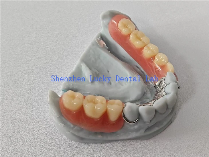 Customized 3D Print Dental Partial Acrylic Denture With Lingual Plate Manufacturers