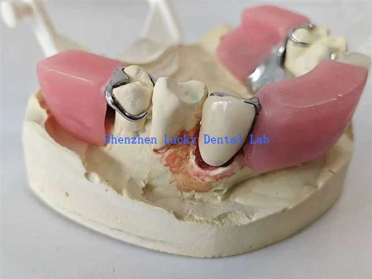 Dental Precision Attachment Of The Bolt-Channel With Metal Framework And Bite Block